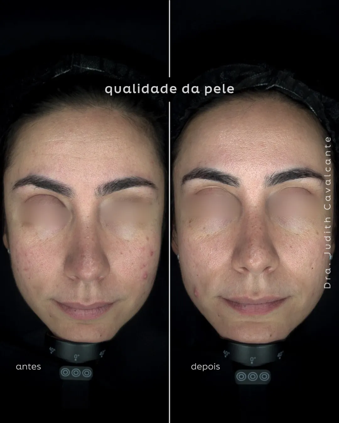 Tratamento acne