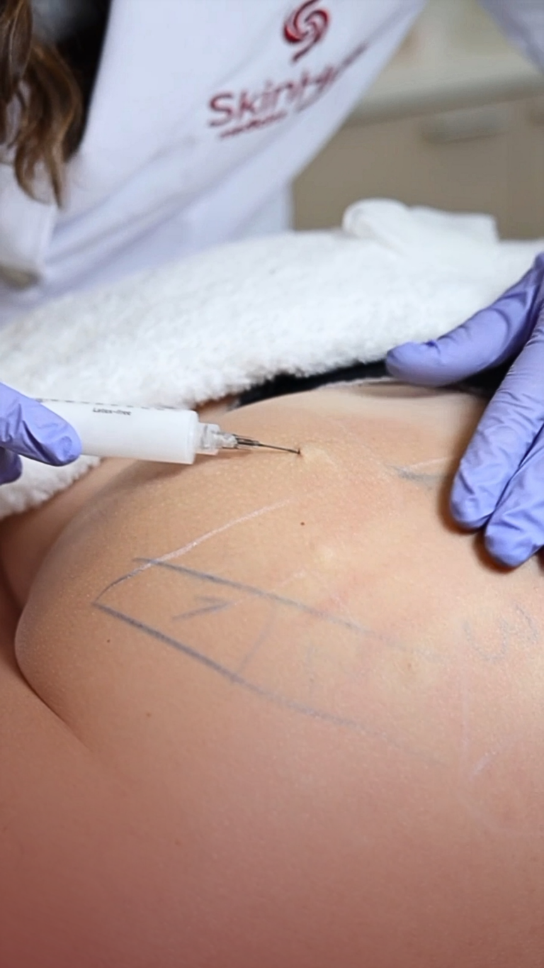 Bioestimulador de Gluteo ao alto