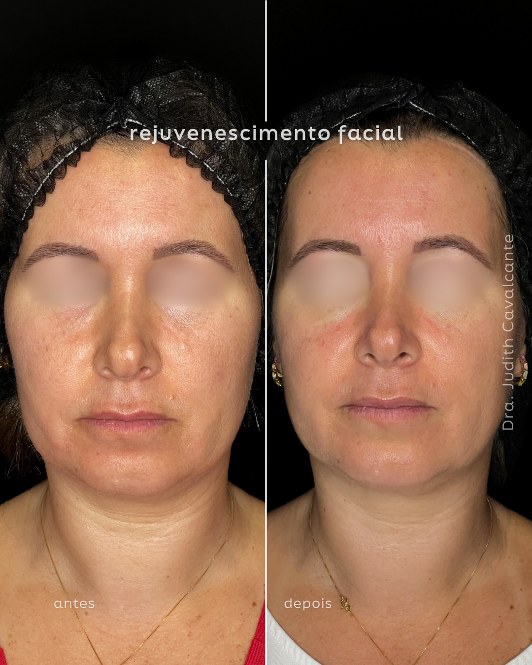 Rejuvenescimento Harmonioso: A Sinergia do Ultraformer MPT e Bioestimuladores
