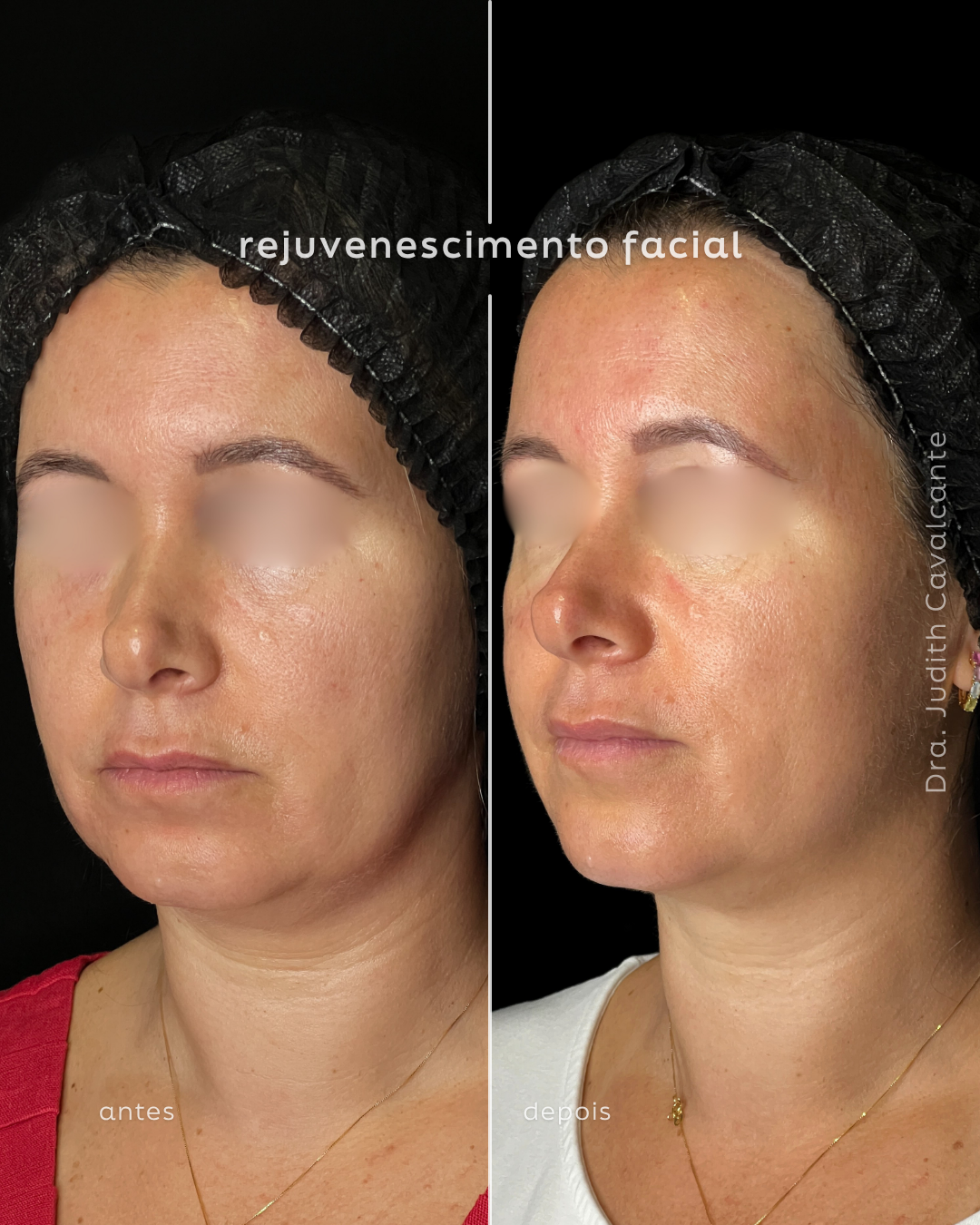 Rejuvenescimento Harmonioso: A Sinergia do Ultraformer MPT e Bioestimuladores