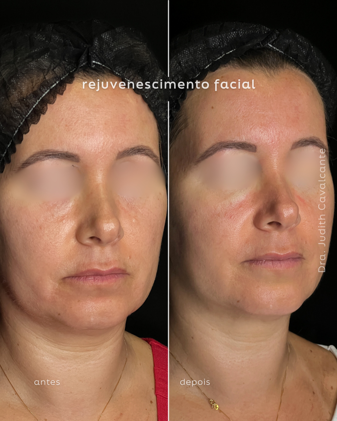 Rejuvenescimento Harmonioso: A Sinergia do Ultraformer MPT e Bioestimuladores