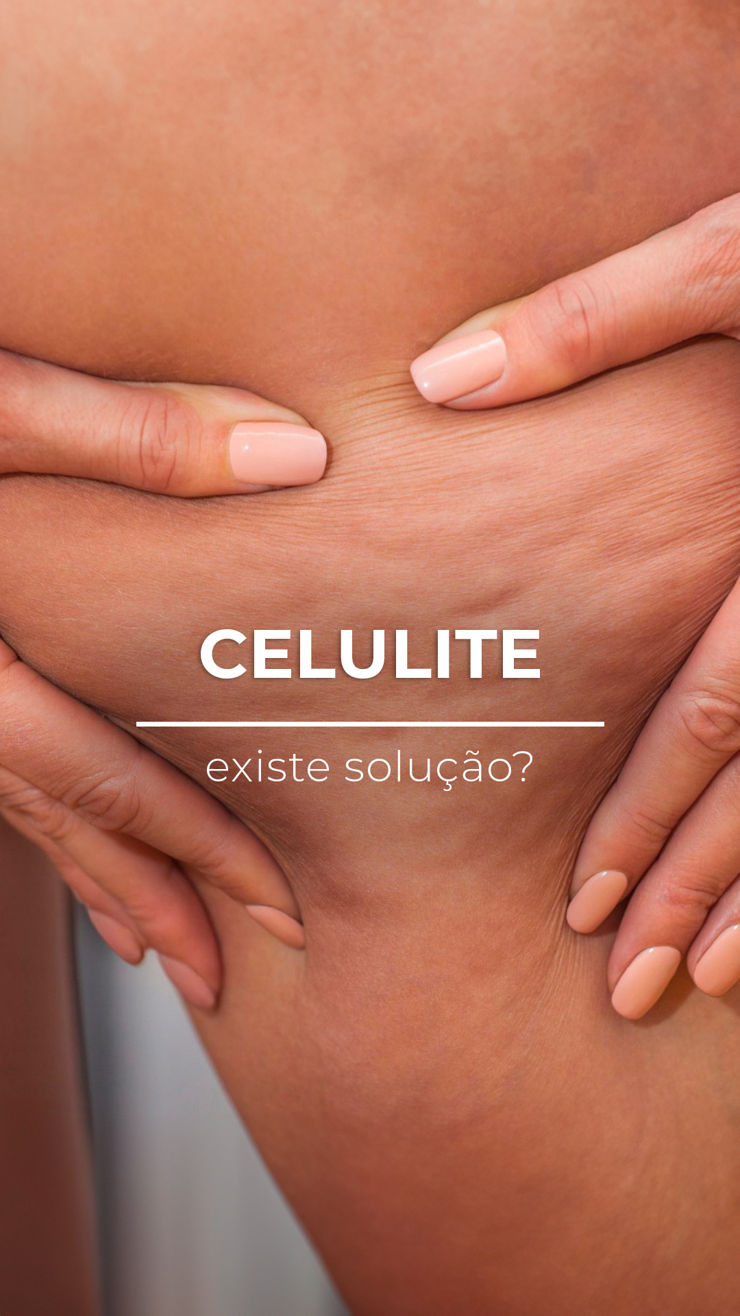 Tratar Celulite: Como Abordar as Diferentes Formas de Alteração Cutânea