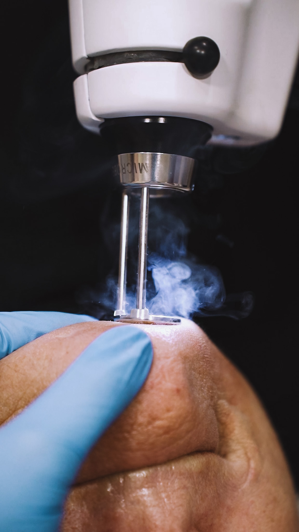 Laser Erbium: A Tecnologia Avançada Para Rejuvenescimento e Cicatrizes de Acne