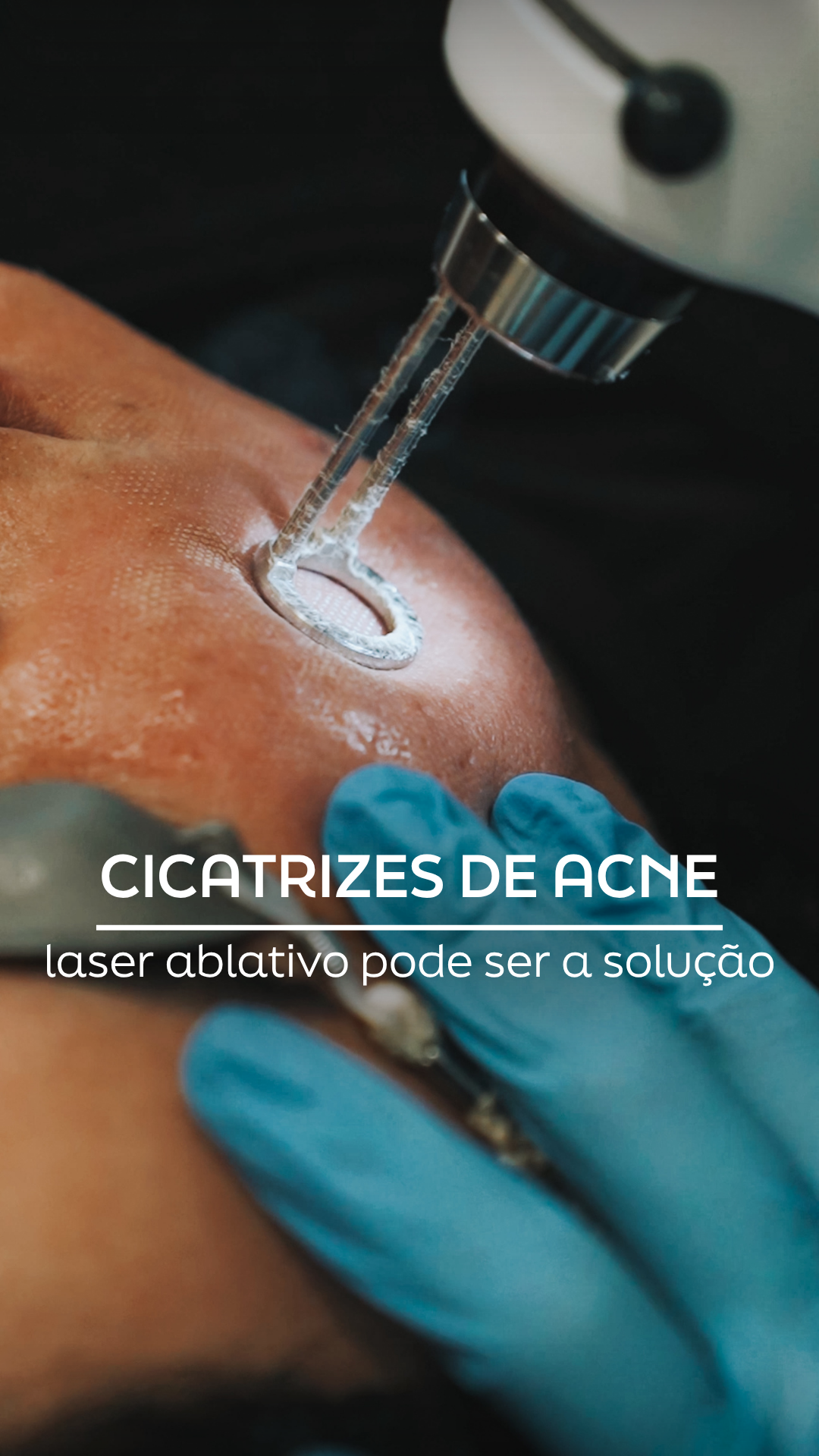 Cicatrizes de Acne: Reestruturação Cutânea Profunda com Laser Erbium no Porto