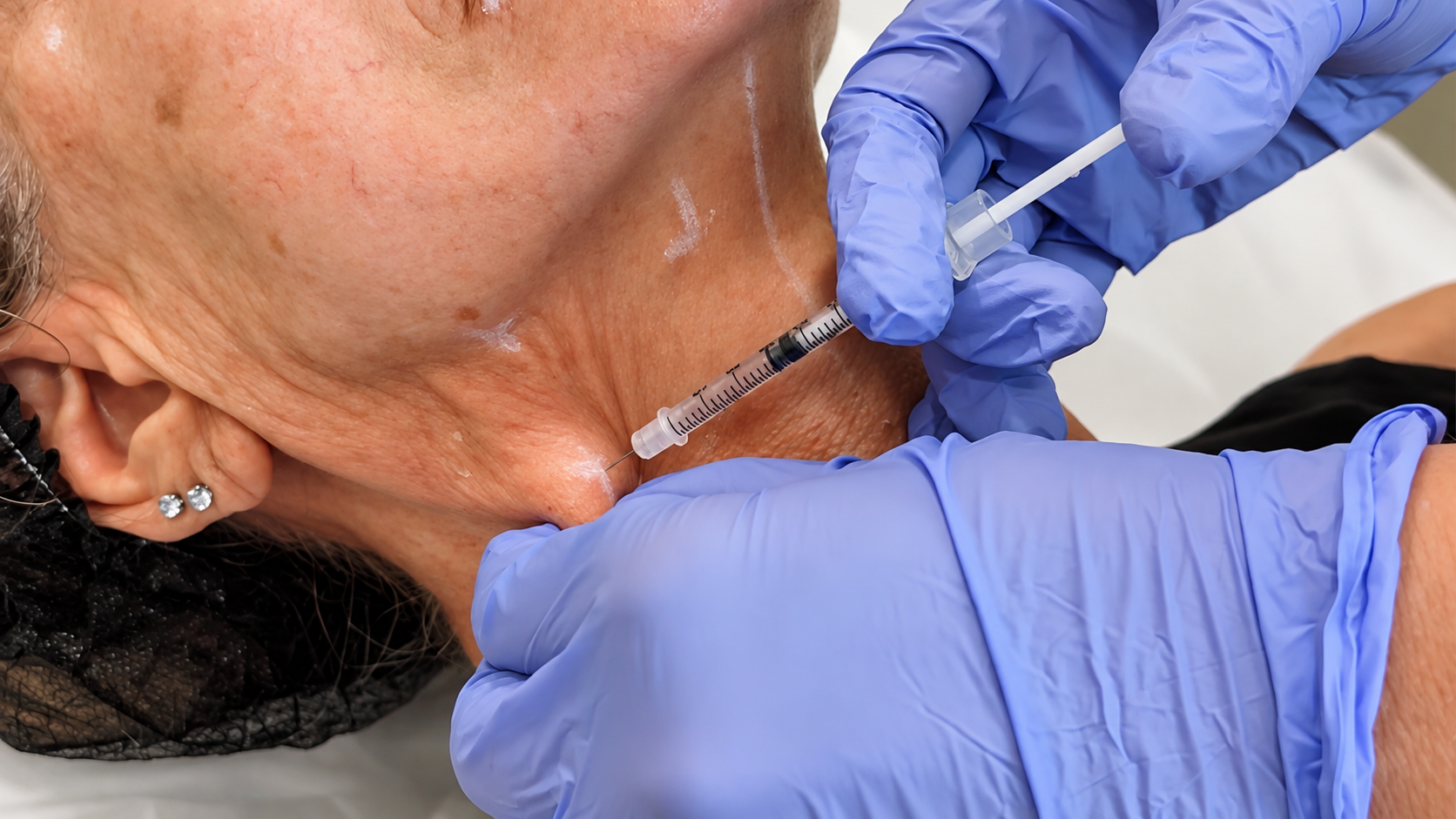 Botox Pescoço