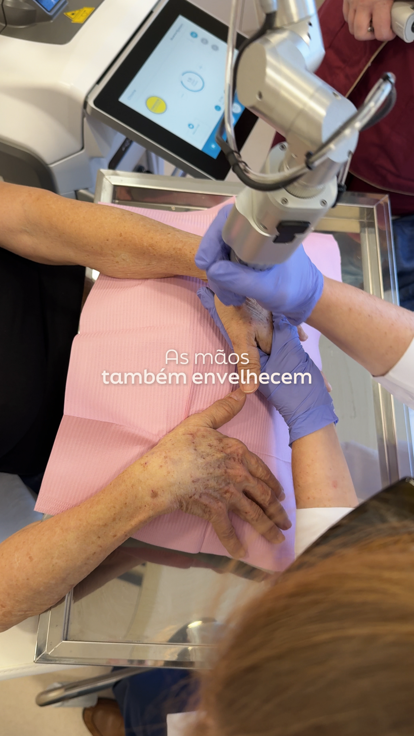 Rejuvenescimento das Mãos: Como Tratar Manchas e Perda de Volume no Porto
