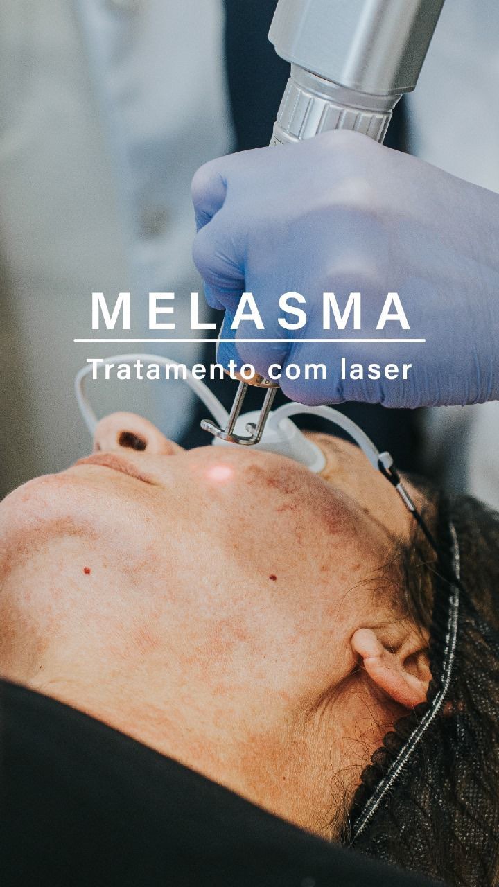 Tratamento Melasma: Como Controlar as Manchas Rosto-Solares
